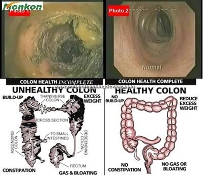 Colon Hydrotherapy Diet